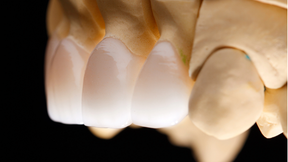 Porcelain Crown