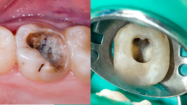 Endodontic treatment
