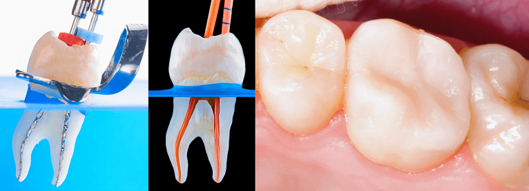 Endodontic treatment