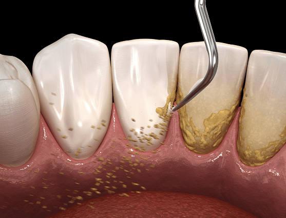 Gum Scaling