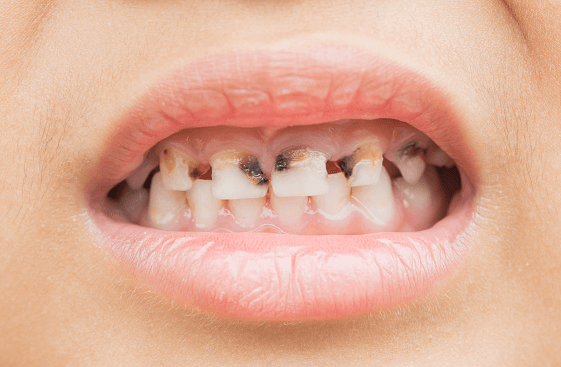 Milk Bottle Caries
