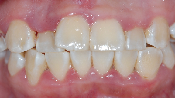 Gum Treatment